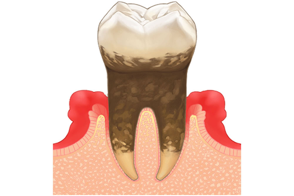 歯周病に効果的